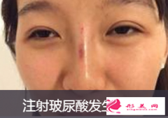 注射隆鼻取出后還能隆鼻嗎？