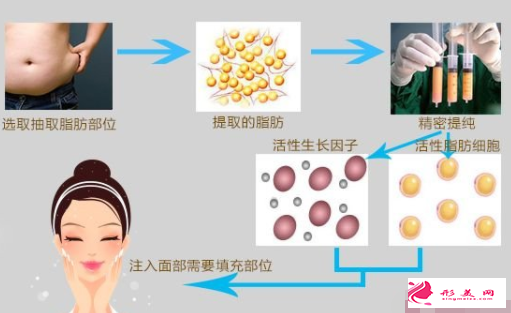 脂肪豐太陽穴后要注意什么