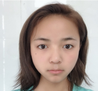 長(zhǎng)沙美萊整形醫(yī)院雙眼皮真人案例：眼睛大了不少~