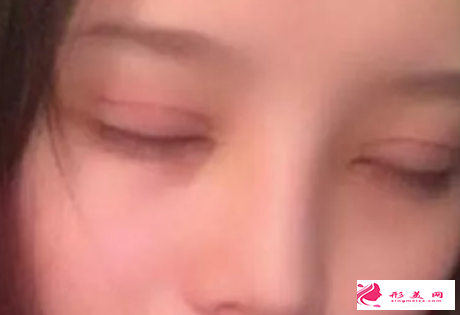 疤痕體質(zhì)可以割雙眼皮嗎