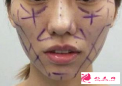 脂肪細(xì)胞填充面部后存活效果好嗎？