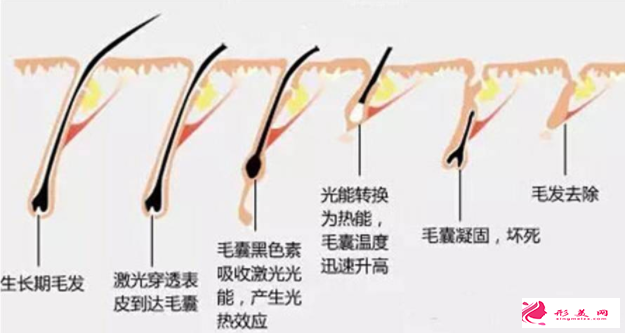 激光脫毛效果能保持多久