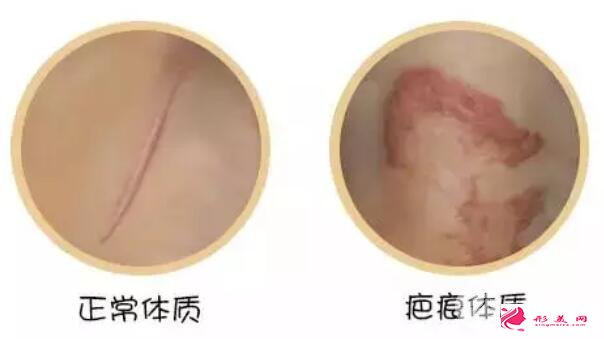 疤痕體質(zhì)有什么特征