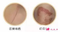 常說的疤痕體質(zhì)能做整形美容嗎？
