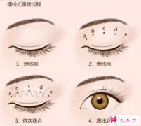 眼皮松弛也能做埋線雙眼皮嗎？