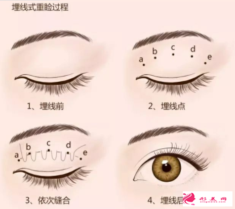 眼皮松弛也能做埋線雙眼皮嗎