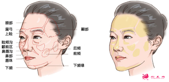 自體脂肪填充面部會失敗嗎