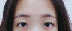 外切去眼袋手術(shù)效果，會(huì)留疤嗎？