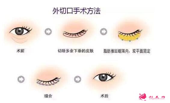 外切去眼袋手術(shù)效果怎么樣?