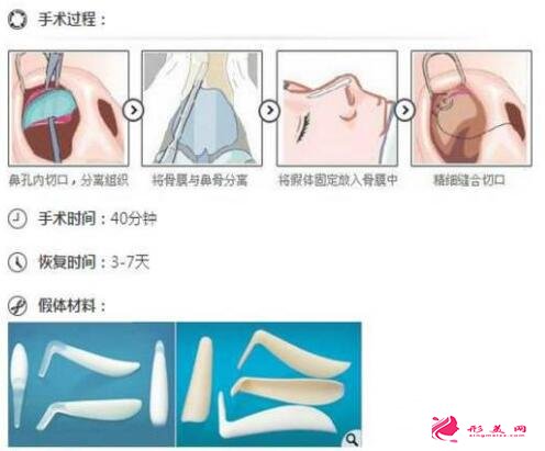 硅膠隆鼻手術(shù)的原理是啥?