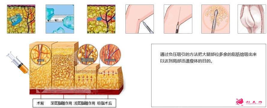 吸脂瘦大腿腫脹期是多久？多久能看到效果？