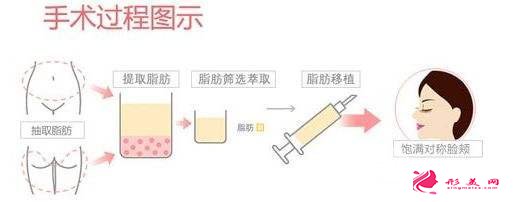 全面部自體脂肪填充大概需要多少錢？