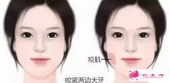 瘦臉針費(fèi)用受哪些因素影響？