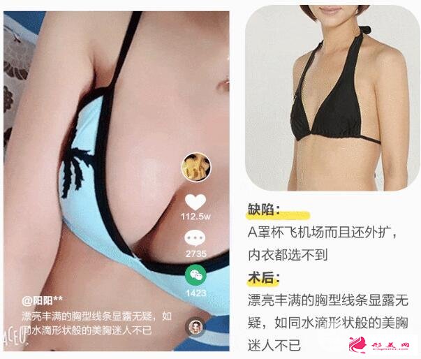 自體隆胸手術(shù)失敗修復效果好不好 案例圖