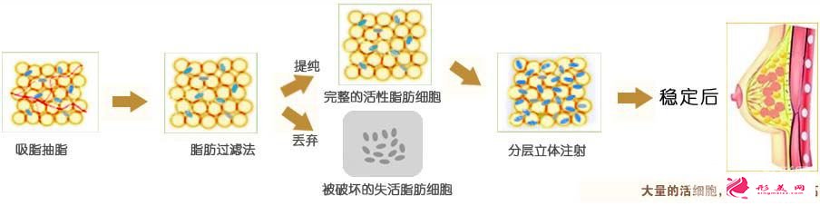 自體隆胸手術(shù)原理