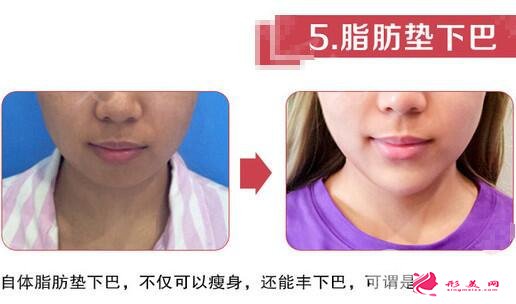 自體脂肪墊下巴效果