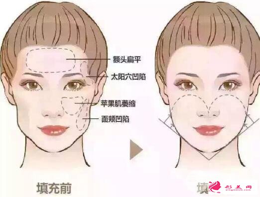自體脂肪墊下巴效果