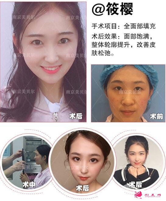 自體脂肪墊下巴效果好不好