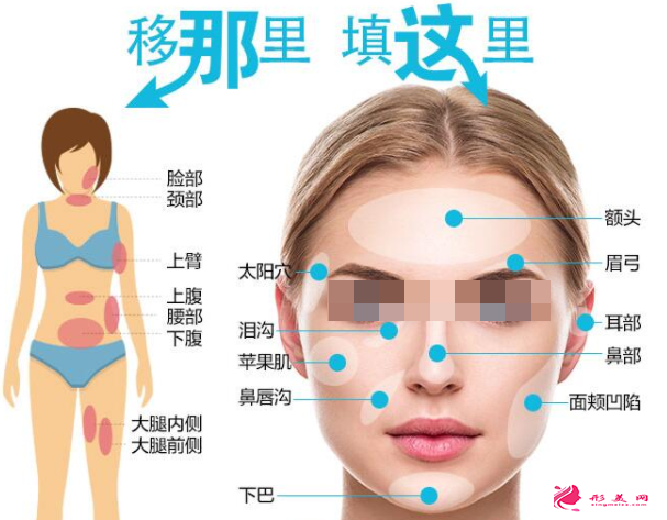 自體脂肪填充的恢復(fù)期是多久