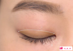 做雙眼皮手術要開眼角嗎？
