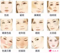 激光祛斑皮膚反黑要怎么辦？