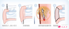大腿吸脂要注意哪些問題？
