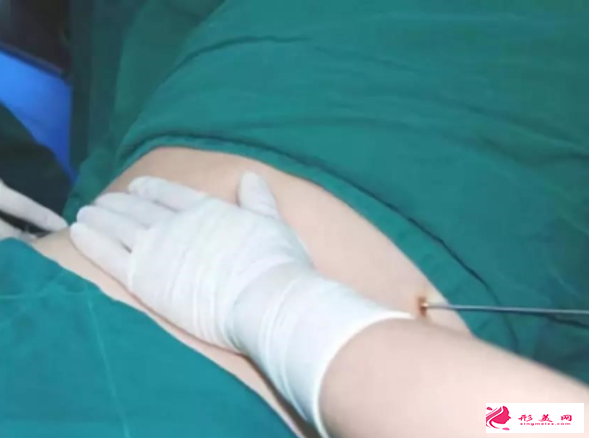 腰腹部吸脂減肥后要注意什么
