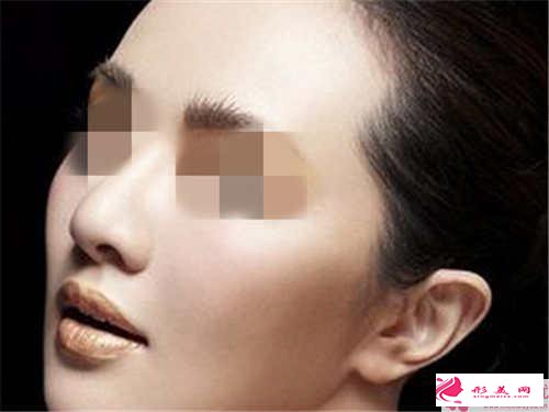 縮小鼻翼術(shù)中的內(nèi)切和外切式有哪些不同點(diǎn)