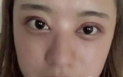 武漢恩吉娜段小兵雙眼皮案例-沙雕小姐姐歡樂(lè)美眼日記