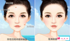 自體脂肪填充面部有風(fēng)險嗎？