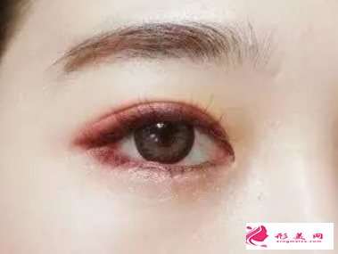 切開(kāi)雙眼皮多久才能拆線