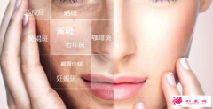 激光祛斑要幾天才能恢復(fù)自然？