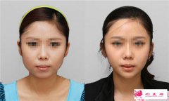 瘦臉針只對(duì)咬肌肥大才有效果嗎?