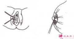 乳暈縮小的優(yōu)缺點(diǎn)和術(shù)后護(hù)理