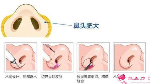 鼻翼縮小手術流程和疤痕護理