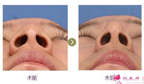 鼻翼縮小手術(shù)的適合人群和優(yōu)缺點(diǎn)
