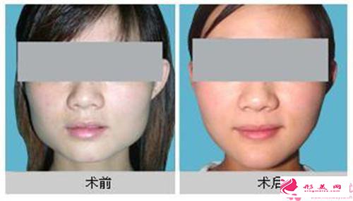 左右下頜角不對(duì)稱怎么辦