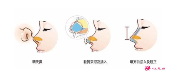 朝天鼻矯正多少錢？這幾點(diǎn)你必須要牢記~