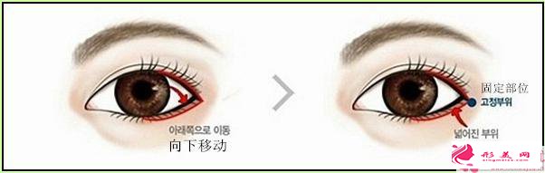 達(dá)拉斯5d鼻子整形手術(shù)治療的費(fèi)用是多少