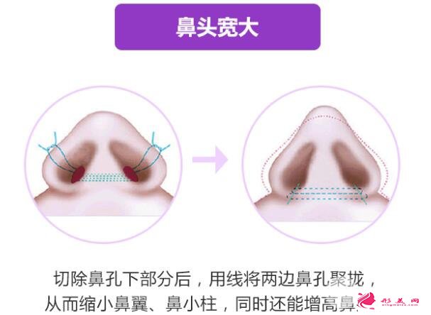 縮小鼻頭多少錢？豬鼻子問題這樣解決~
