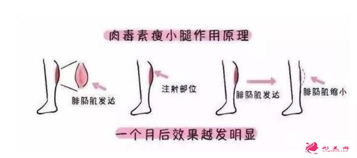 大腿肉瘦腿針能打嗎？瘦腿針的原理請(qǐng)重新審視一下！
