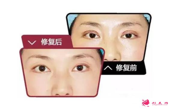雙眼皮修復(fù)前后：假、寬、痕都能修復(fù)自然~