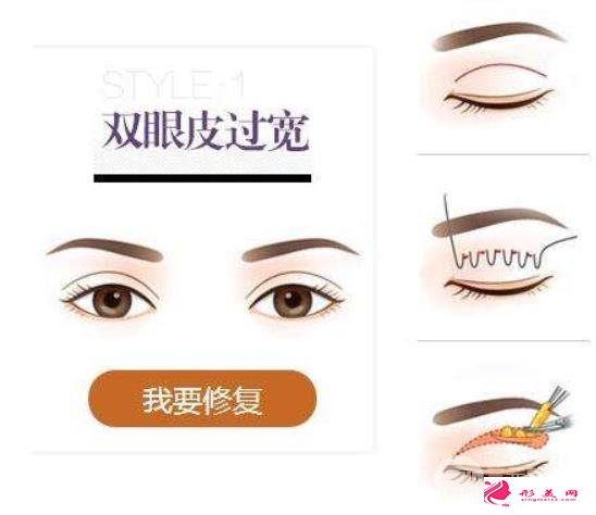 雙眼皮修復(fù)前后：假、寬、痕都能修復(fù)自然~