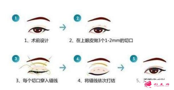 做雙眼皮需要多少錢??？手術(shù)方式不同價(jià)格不一樣~