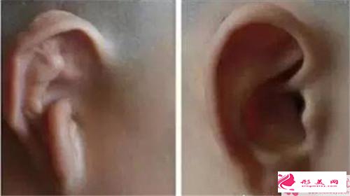 什么是全耳再造整形美容術(shù)做手術(shù)存在疼痛感嗎