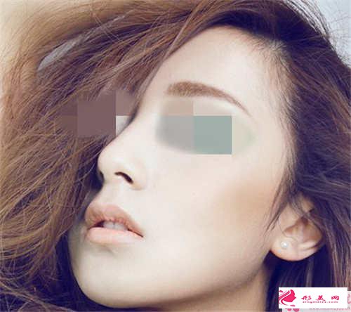 注射式隆鼻一年過后美容效果如何