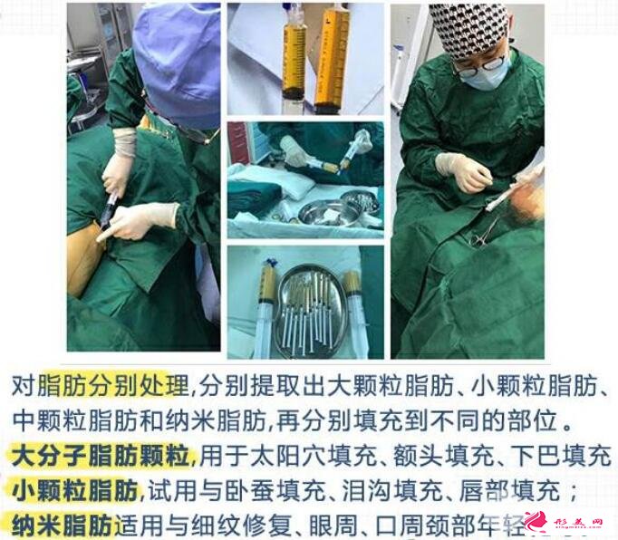 脂肪墊下巴效果好不好