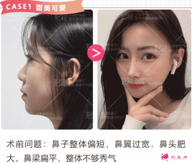 鼻子矯正術(shù)效果圖