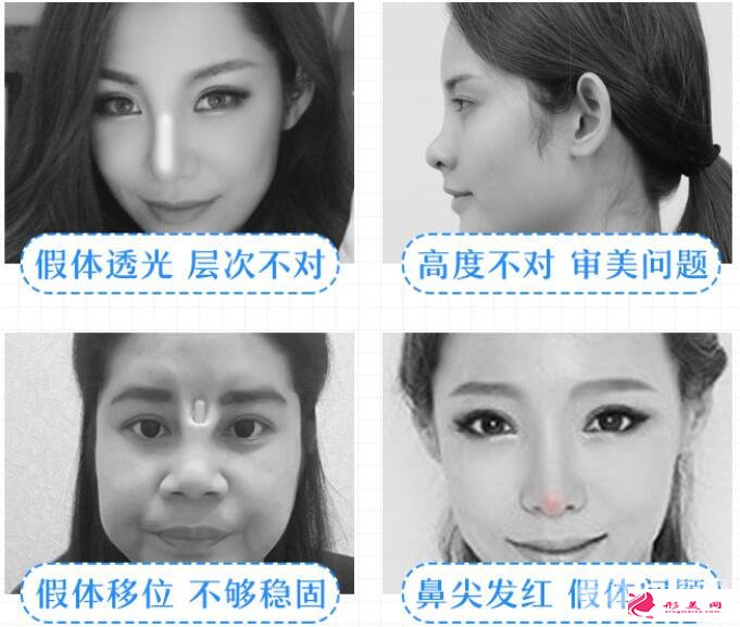 隆鼻失敗怎么辦？別慌，這里有自救指南！