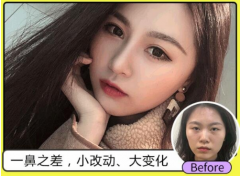 北京硅膠隆鼻價格貴么？